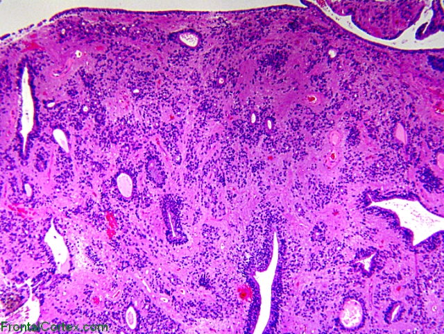 True ependymal rosettes x20